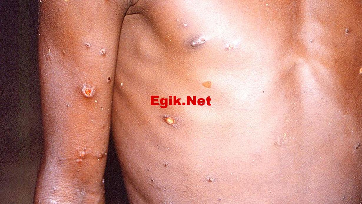 Hindistan’da ilk maymun çiçeği vakasının tespit edildiği açıklandı