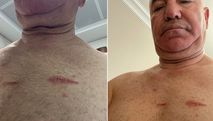 Mahmut Tanal vücudundaki darp izlerini paylaştı