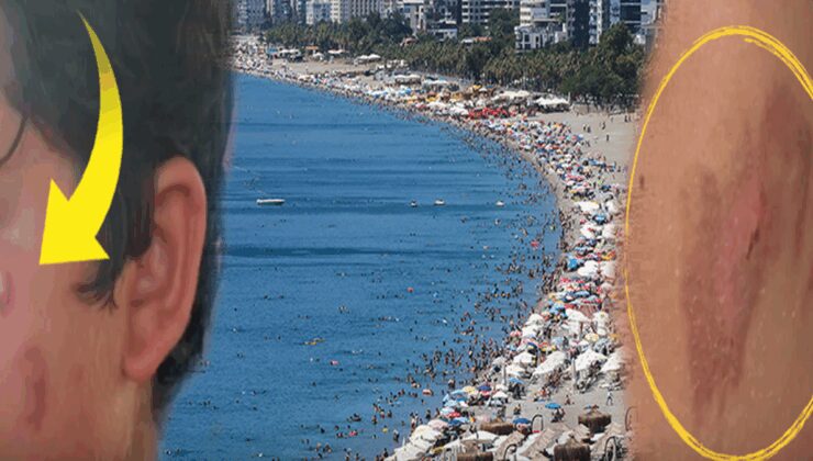 Denize giren yanıklarla çıkıyor: Tatilcilere kötü haber!