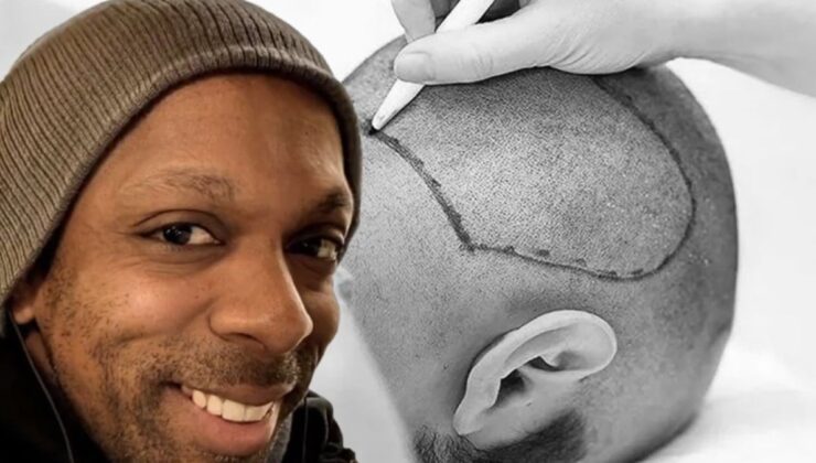 İstanbul’da yaptırdığı saç ekimi sonu oldu!