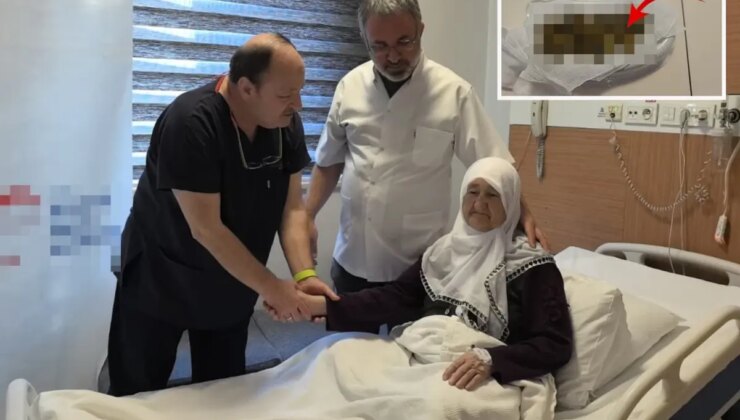 Yaşlı kadının safra kesesinden 213 adet taş çıktı