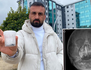 Şiddetli kanama ve akıntı şikayetiyle gitti: 5 yaşındaki Polen’in 2 yıl boyunca burnundaymış! ”Bu nasıl gözden kaçabilir?’