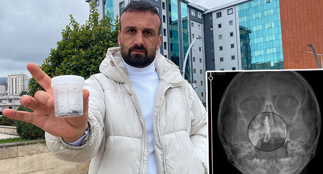 Şiddetli kanama ve akıntı şikayetiyle gitti: 5 yaşındaki Polen’in 2 yıl boyunca burnundaymış! ”Bu nasıl gözden kaçabilir?’